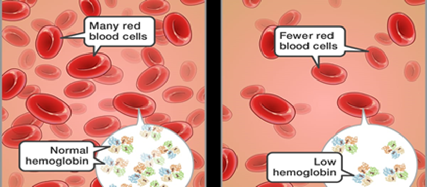 Anemia as a Condition